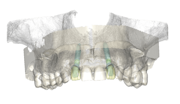 implant, Hawkesbury Dentists